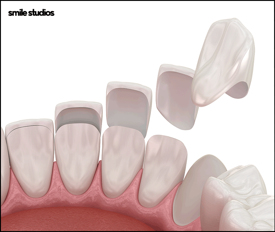 강남라미네이트 기대 효과, 원리, 유지기간 관련 이미지 8