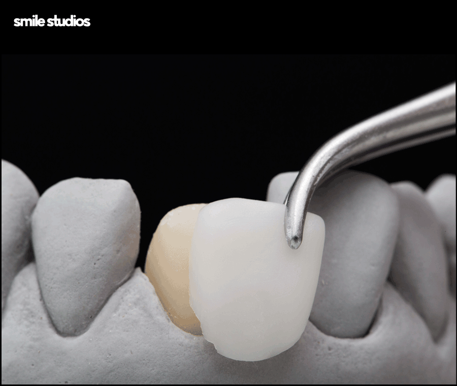 앞니부러짐 치아파절 대처 방법은? ft. 라미네이트 관련 이미지 5