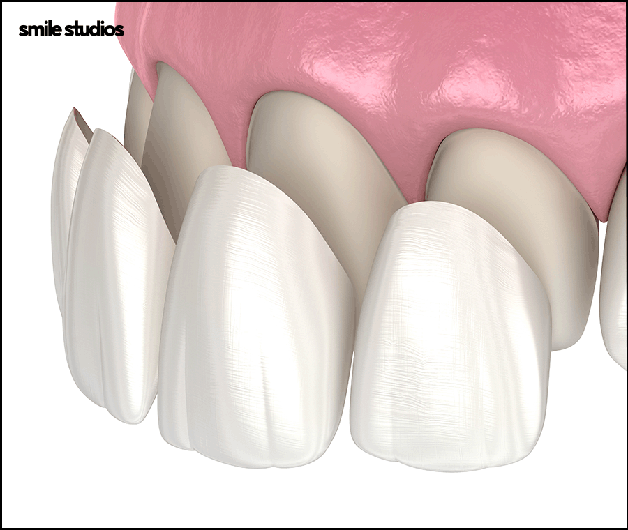 거미스마일 미소의 결함, 해결 방법 ft. 라미네이트 관련 이미지 6