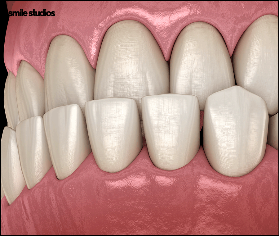 역삼역치과 인비절라인, 브라켓과 차이점 알아보기 관련 이미지 5