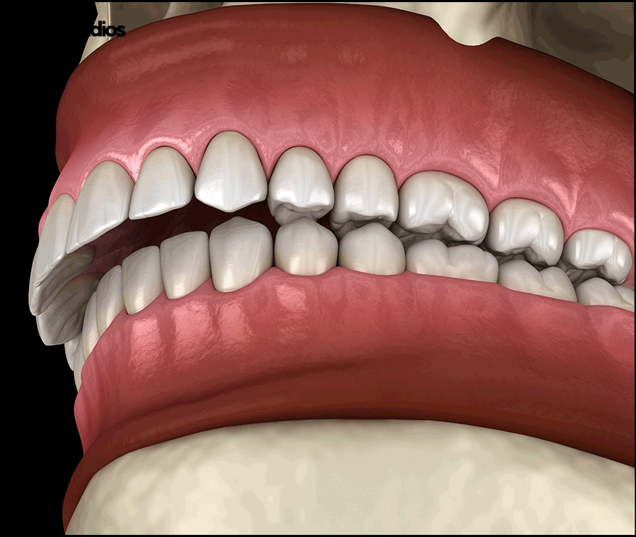 선정릉역치과 인비절라인 교정 전 필수 확인 사항 관련 이미지 4