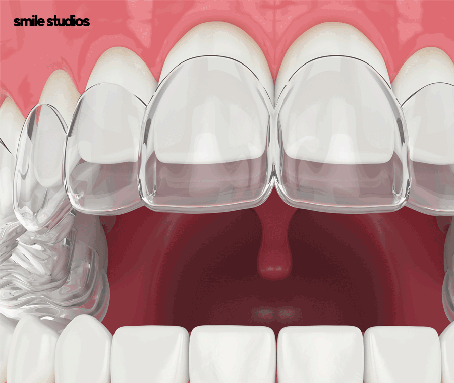 투명교정후기 알아본다면 함께 꼭 확인해야 할 2가지 관련 이미지 6