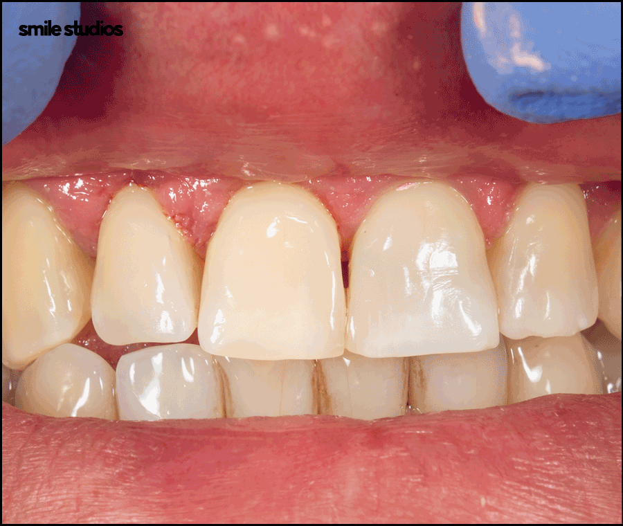 논현역 치과 라미네이트 시술 전 필수 확인 사항 관련 이미지 6