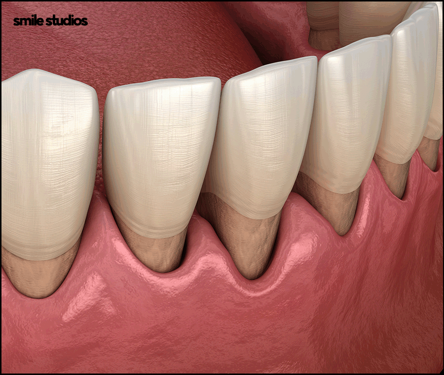 치경부마모증, 주저앉은 잇몸? 원인과 해결 방법 관련 이미지 2