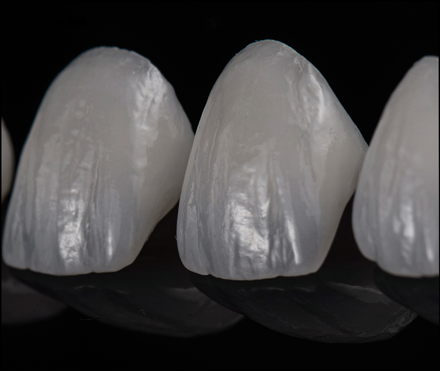 치아무삭제라미네이트 사실과 오해 알아보기 관련 이미지 7