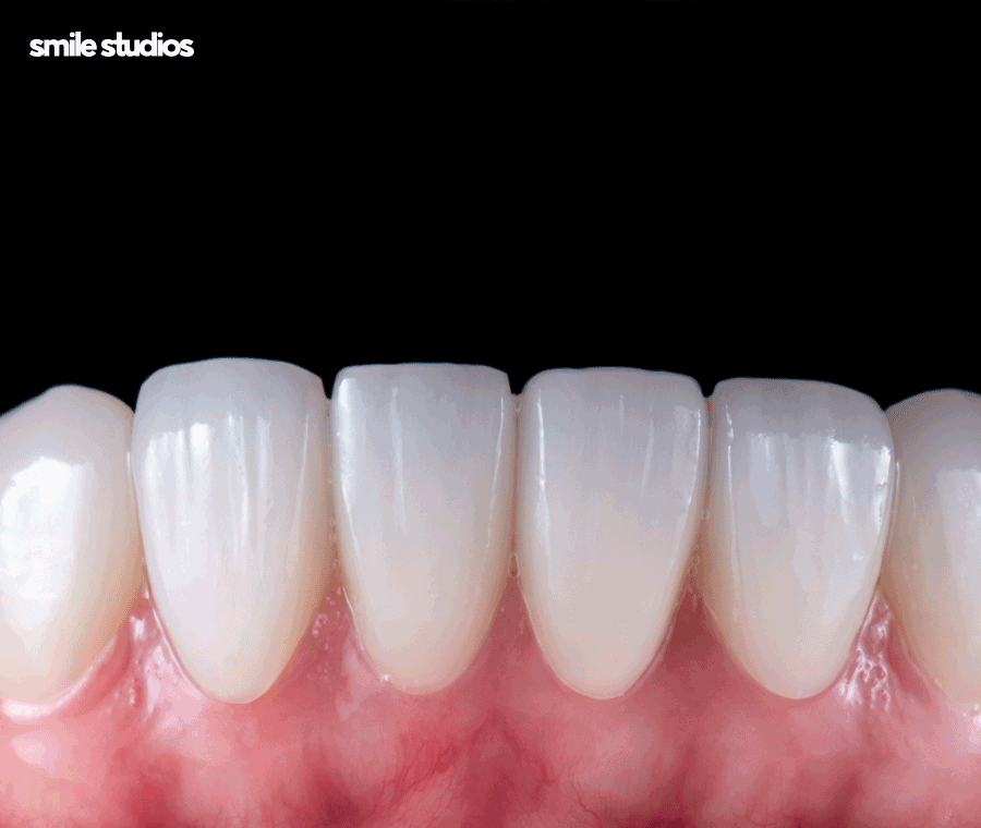 이빨교정비용 좌우하는 기준점 알아보기 관련 이미지 9