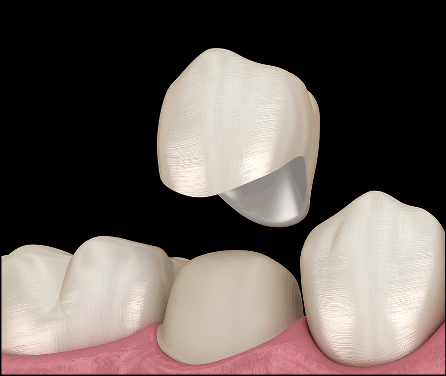 강남라미네이트 기대 효과, 원리, 유지기간 관련 이미지 6