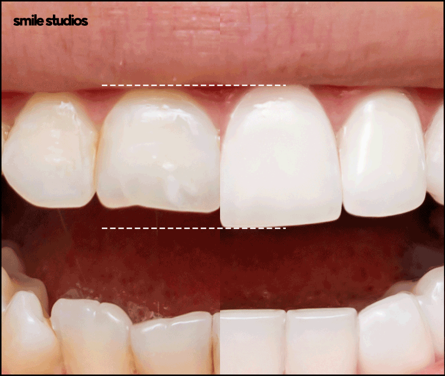 누런이빨 라미네이트 보완 효과, 미백과 차이점 관련 이미지 6