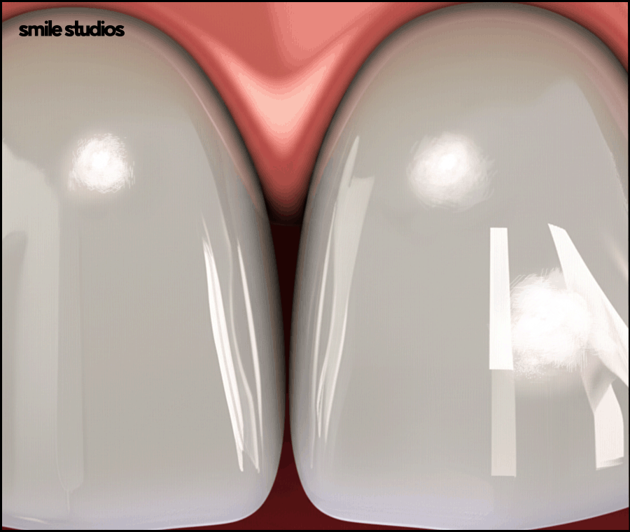 치아반점치 흰얼룩 발생하는 원인, 회복 방법 관련 이미지 5