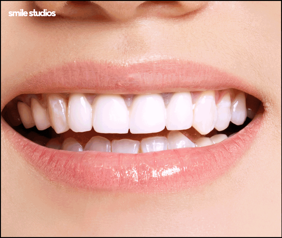 치아반점치 흰얼룩 발생하는 원인, 회복 방법 관련 이미지 10