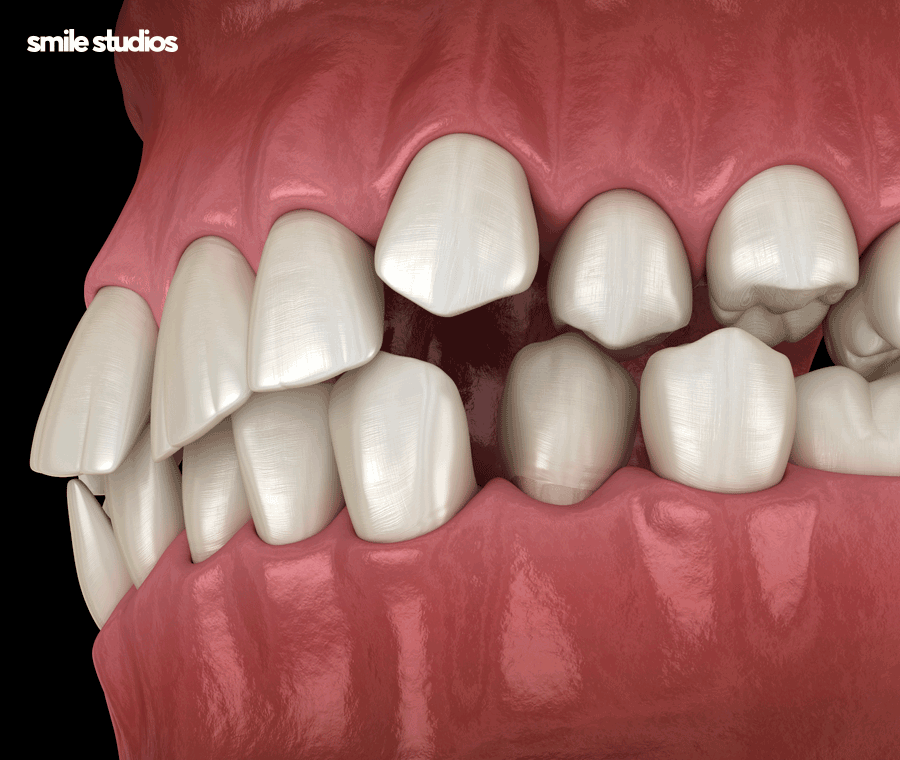 부정교합 교정기(투명) 종류 및 특징 알아보기 관련 이미지 2