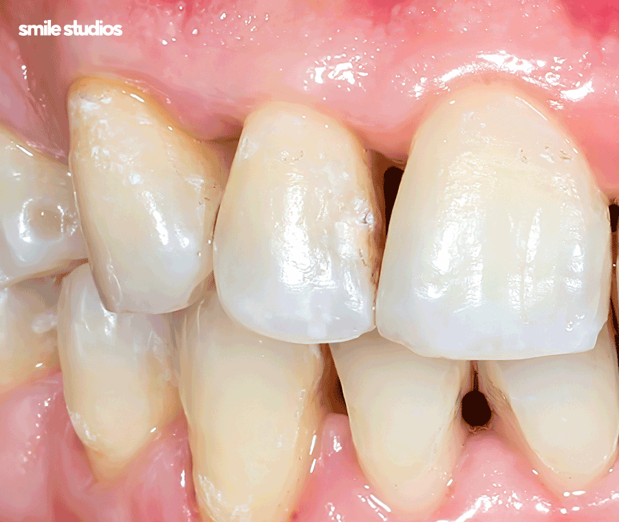 논현 라미네이트 시술 고민된다면 필수체크 관련 이미지 2