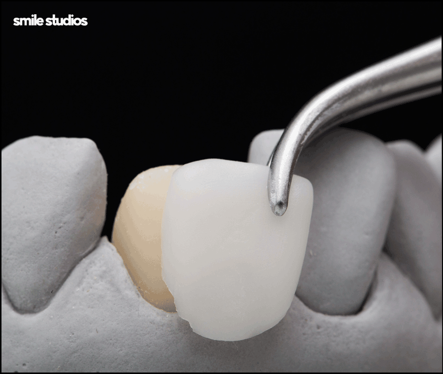 라미네이트 변색, 발생하는 이유, 시점, 대처 방법 관련 이미지 7