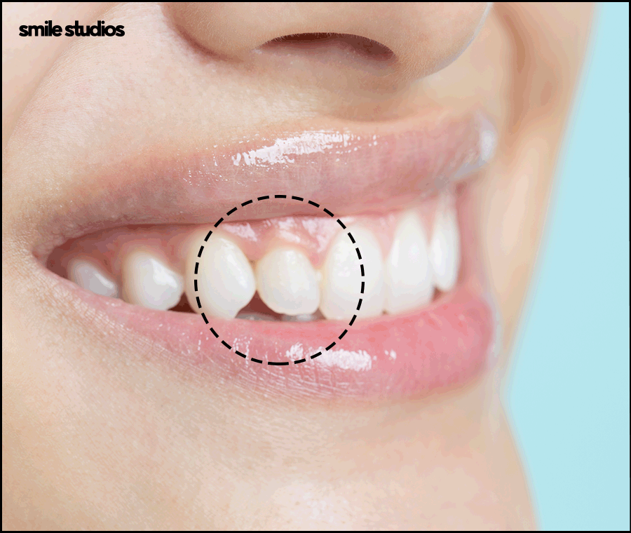 왜소치라미네이트 심미성 개선 효과, 필요성 관련 이미지 5