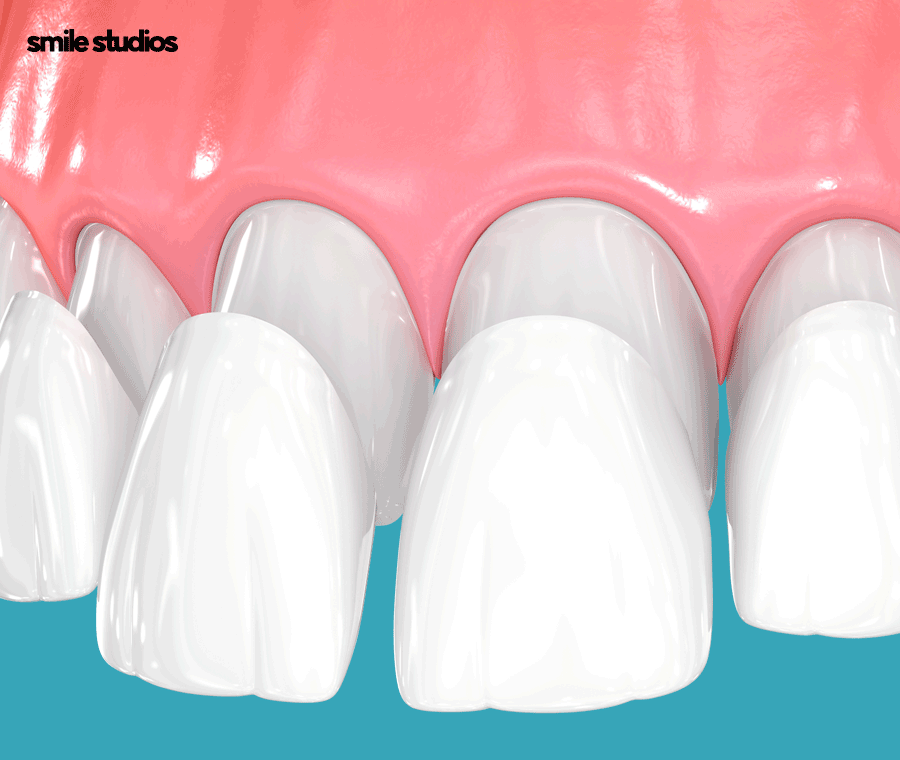 강남 신사역 치과 앞니 벌어짐 교정vs라미네이트 관련 이미지 8