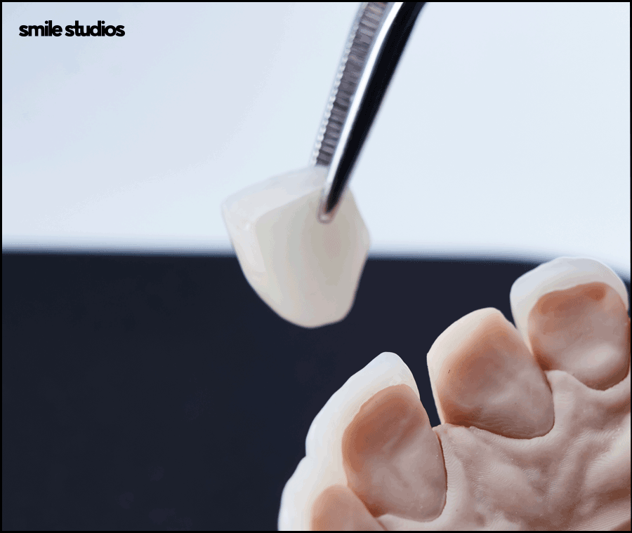 연예인 라미네이트 자연스러운 미소의 비밀은? 관련 이미지 3