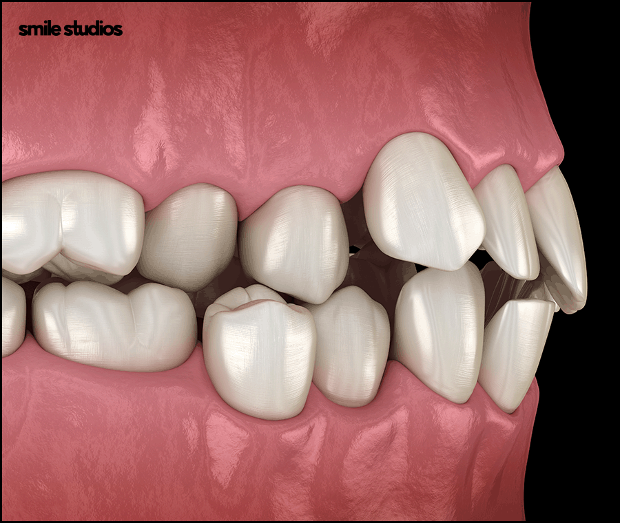 강남 인비절라인 찾는 이유, 치료 가능 범위는? 관련 이미지 6