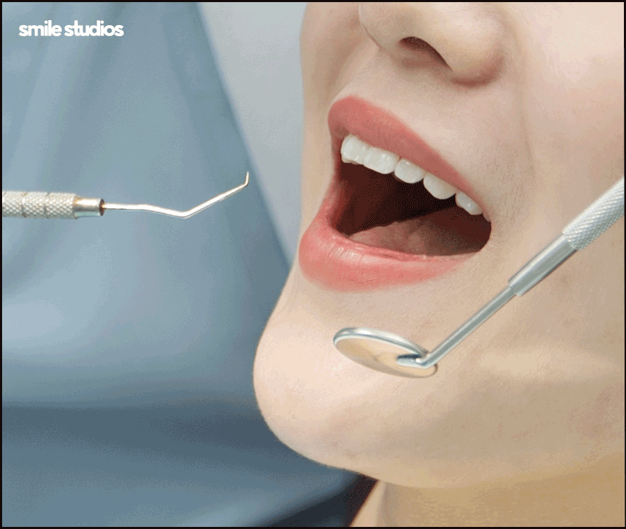 라미네이트 빠짐, 재부착 가능할까요? +대처방법 관련 이미지 6