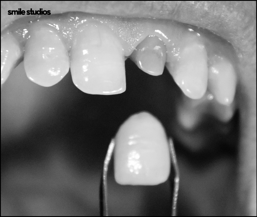 치경부마모증, 주저앉은 잇몸? 원인과 해결 방법 관련 이미지 10