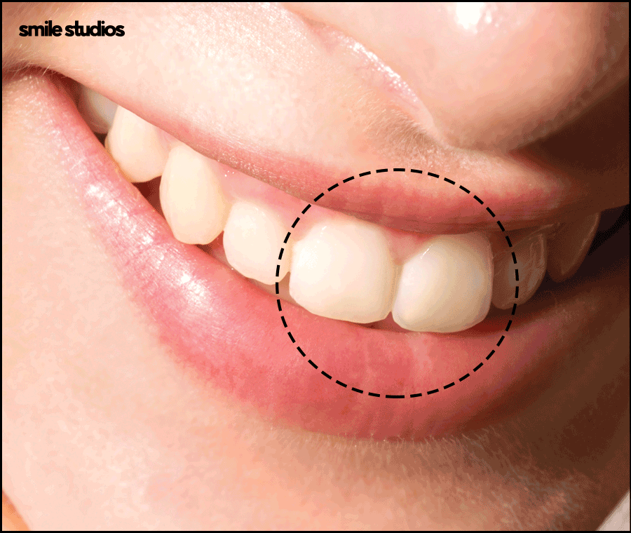 토끼이빨교정, 올바른 정렬을 위한 효과적인 방법은? 관련 이미지 4