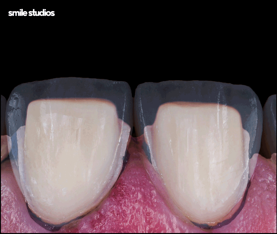 논현역 치과 라미네이트 시술 전 필수 확인 사항 관련 이미지 3