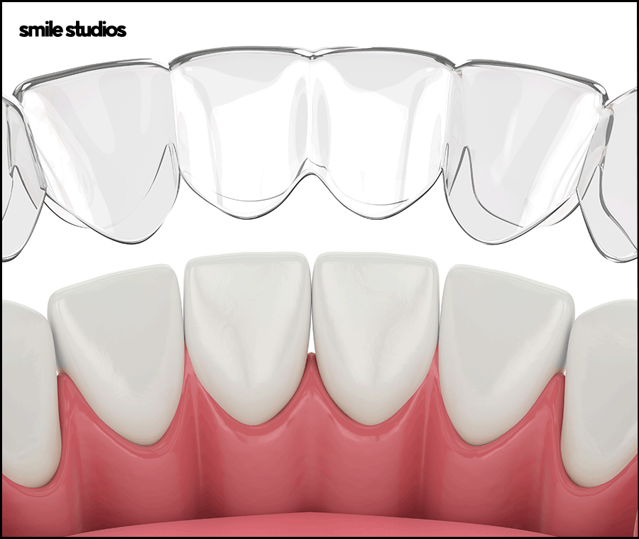 과개교합 교정을 위한 나노라이너 특징 총 정리 관련 이미지 6
