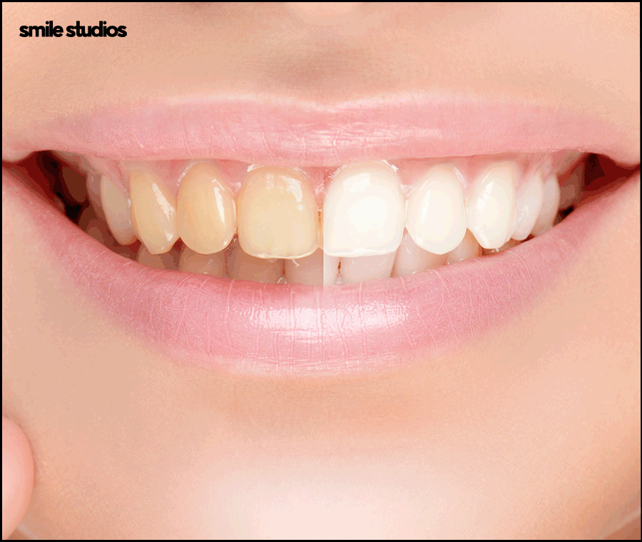 앞니무삭제라미네이트 핵심이 되는 사항은? 관련 이미지 4