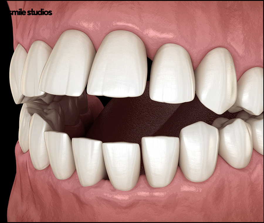 선정릉역치과 인비절라인 교정 전 필수 확인 사항 관련 이미지 2