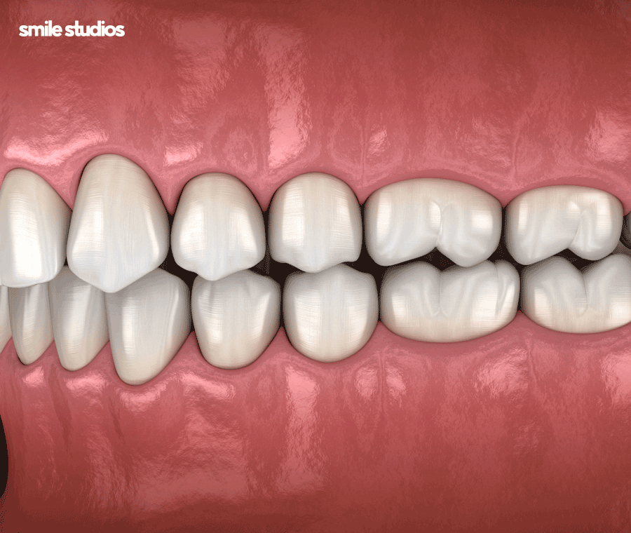 이빨교정비용 좌우하는 기준점 알아보기 관련 이미지 6