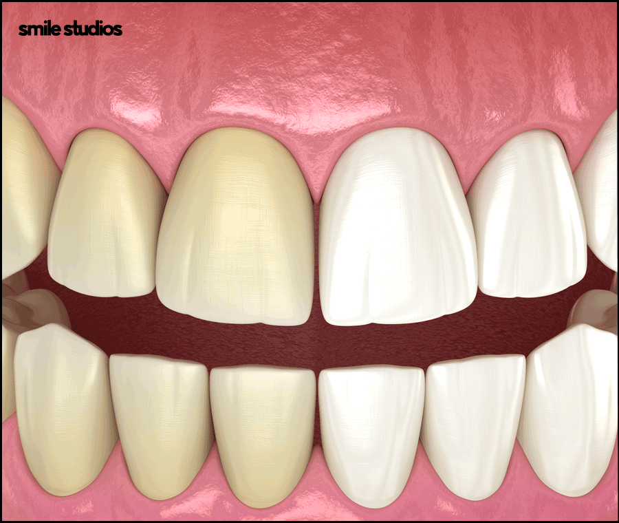 누런이빨 라미네이트 보완 효과, 미백과 차이점 관련 이미지 3