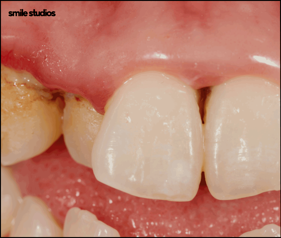 압구정로데오치과 라미네이트 하기 전 체크할 사항 관련 이미지 2