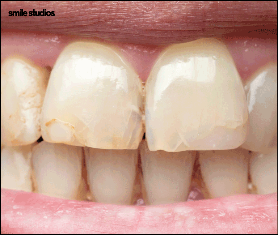 라미네이트 재시술 필요한 케이스, 주의사항 정리 관련 이미지 4