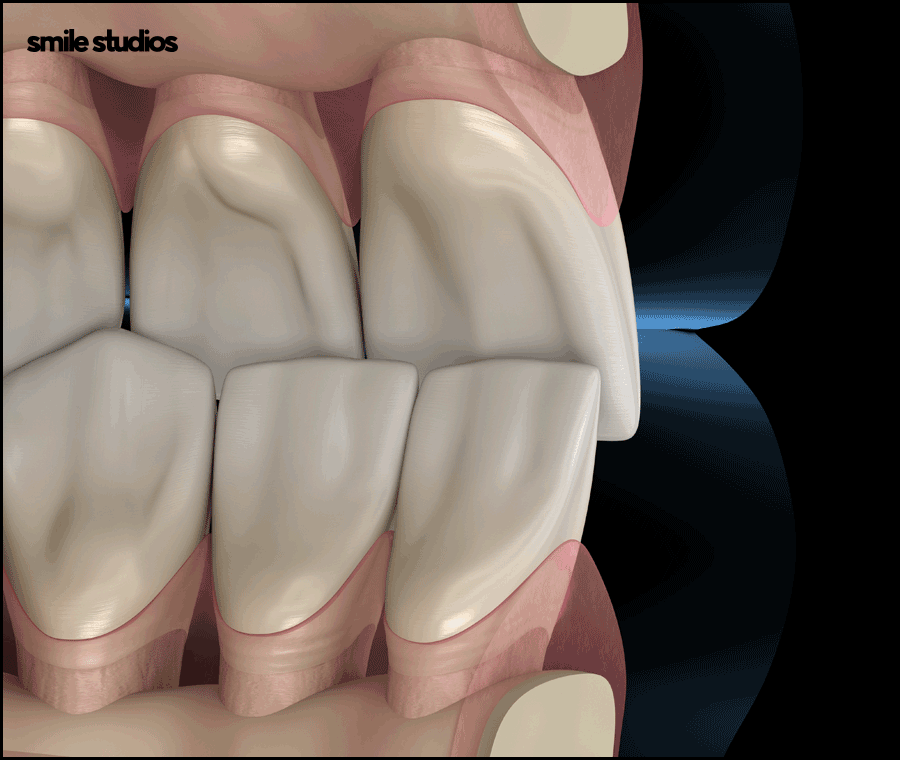 강남치과의원, 나노라이너 특징 및 효과 알아보기 관련 이미지 4