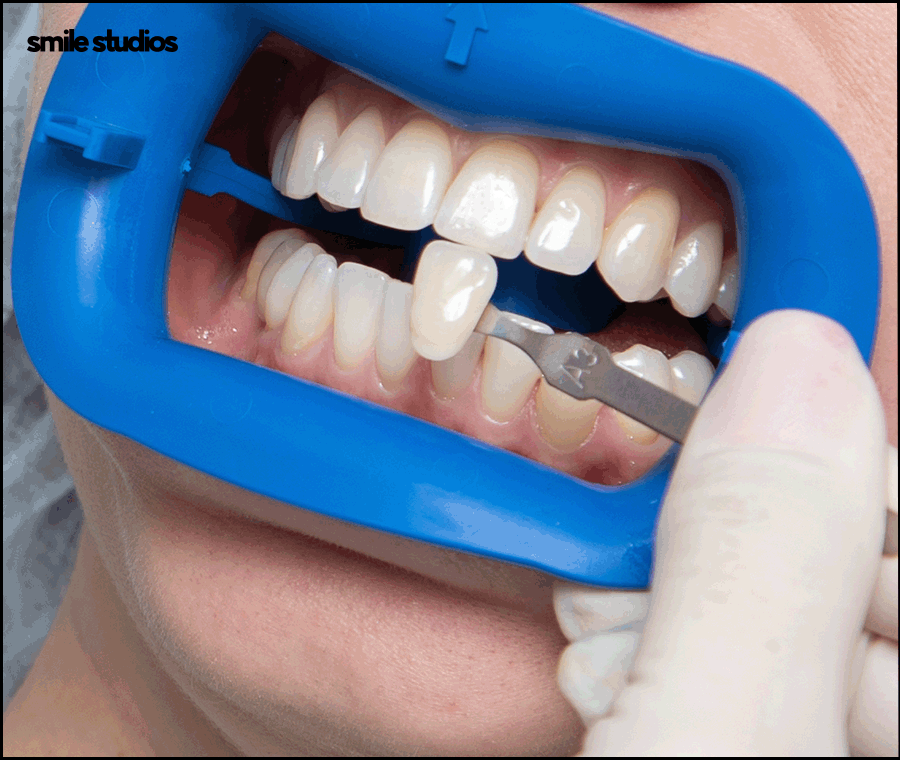 앞니 라미네이트가격 확인 시 같이 체크할 OO은? 관련 이미지 6