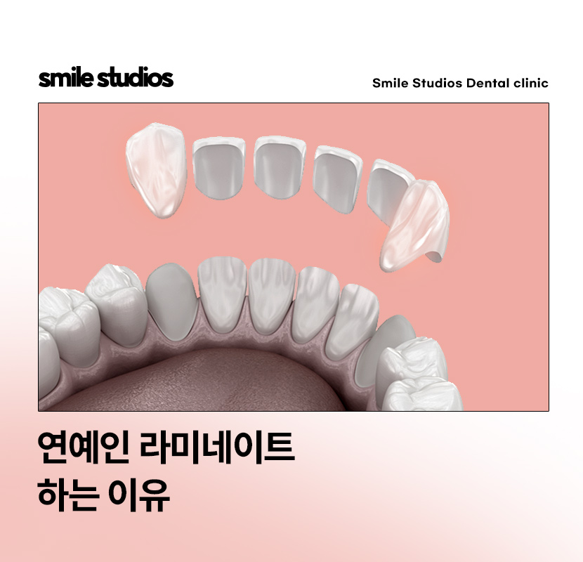 연예인라미네이트 선호도가 높은 이유, 효과 관련 이미지 1