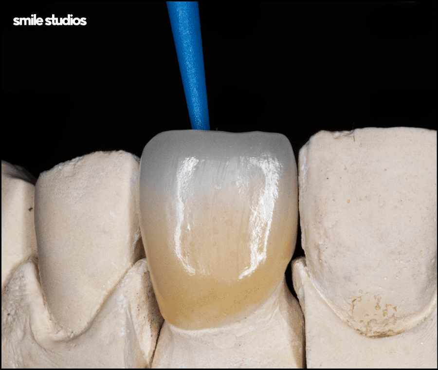 앞니부러짐 치아파절 대처 방법은? ft. 라미네이트 관련 이미지 8