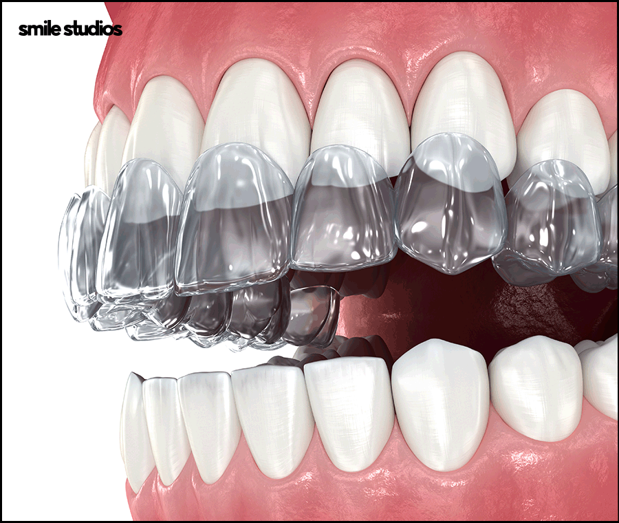 인비절라인 유지장치 착용 기간, 주의사항 알아보기 관련 이미지 8