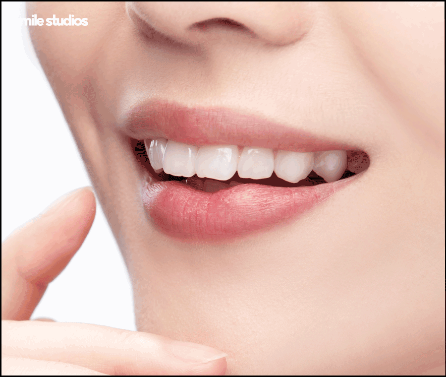 거미스마일 미소의 결함, 해결 방법 ft. 라미네이트 관련 이미지 9