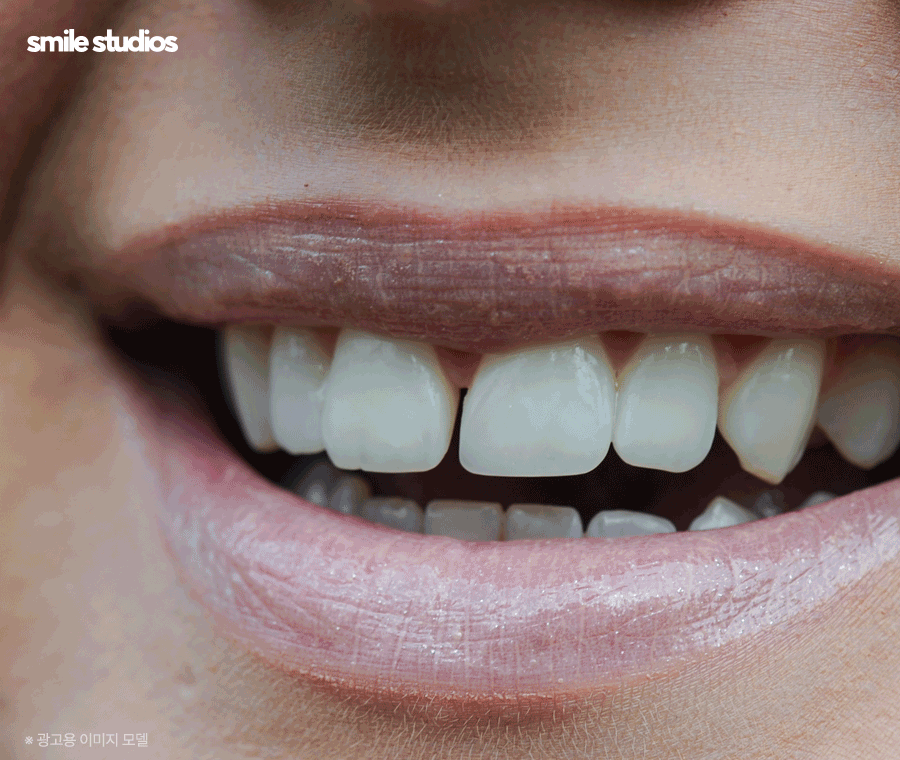 이빨교정비용 좌우하는 기준점 알아보기 관련 이미지 7