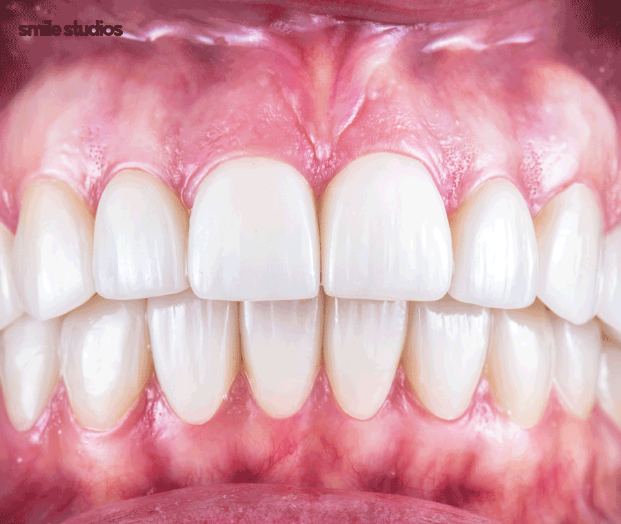 강남 신사역 치과 앞니 벌어짐 교정vs라미네이트 관련 이미지 3
