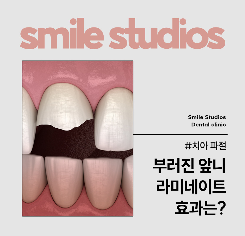 앞니부러짐 치아파절 대처 방법은? ft. 라미네이트 관련 이미지 1