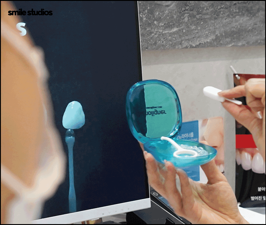 과개교합 교정을 위한 나노라이너 특징 총 정리 관련 이미지 8