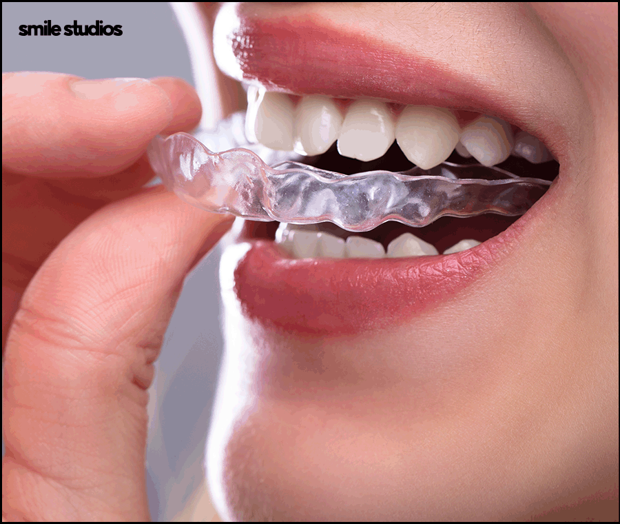 덧니라미네이트 해결 가능할까요? ft. 가능한 케이스 관련 이미지 8