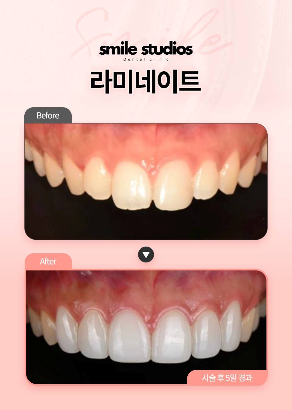 논현동치과, 라미네이트? 교정? 고민 말고 관련 이미지 9