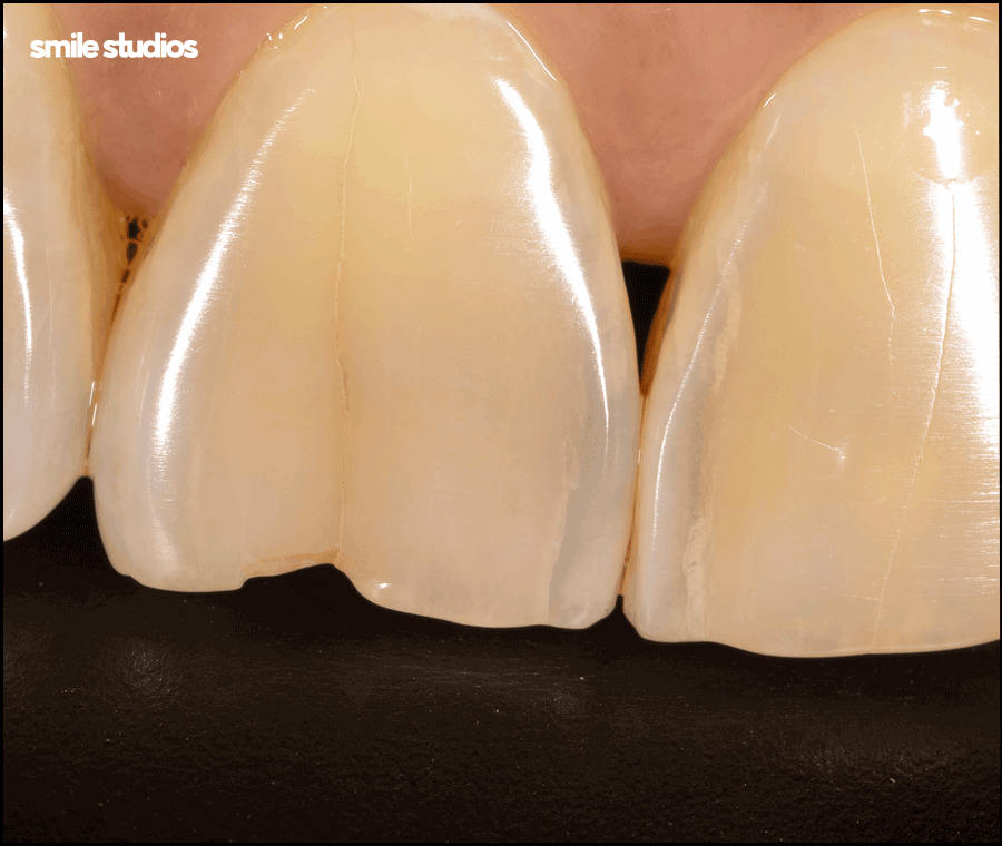 라미네이트 깨짐 대처, 어떻게 해야할까요? 방법 정리 관련 이미지 4