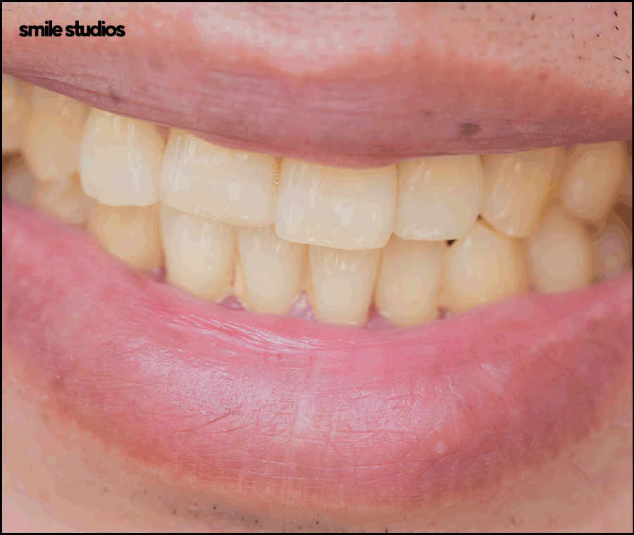 압구정 라미네이트 성공적인 결과를 만드는 핵심은? 관련 이미지 2