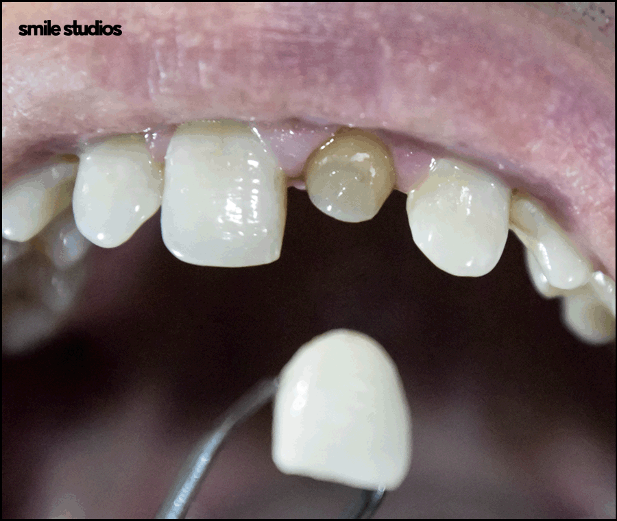 치아무삭제라미네이트 사실과 오해 알아보기 관련 이미지 4