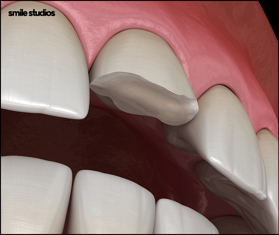 도산대로치과 앞니 라미네이트 크라운 차이점 관련 이미지 6