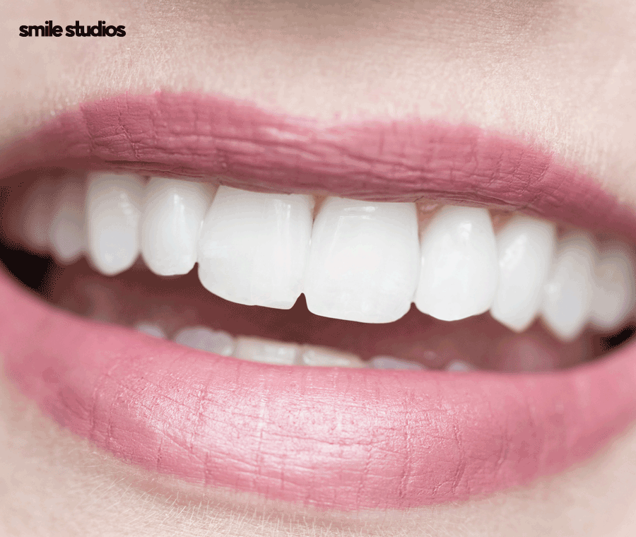 압구정 라미네이트 성공적인 결과를 만드는 핵심은? 관련 이미지 6