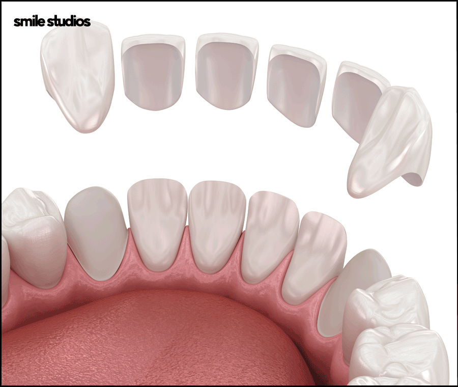 깨진이빨(앞니깨짐) 라미네이트 시술 효과는? 관련 이미지 3